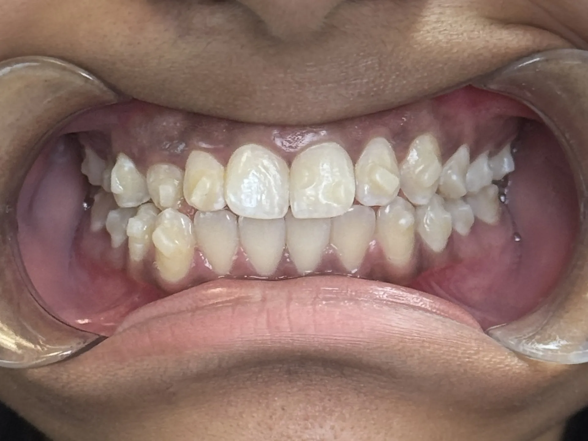 Case 4 after