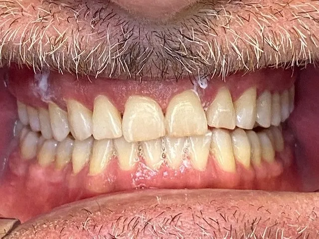 Case 6 after